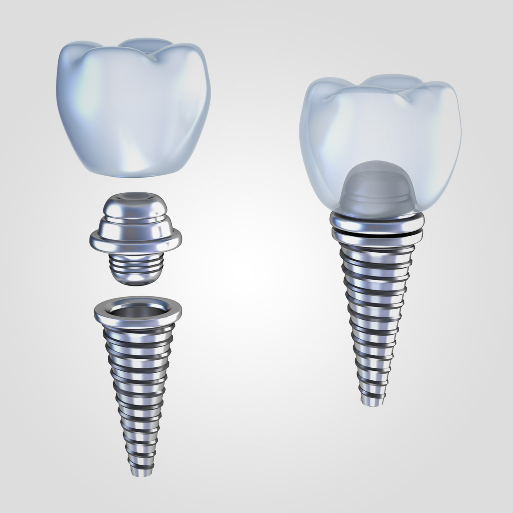 implantes dentales en Roquetes Sant Pere de Ribes