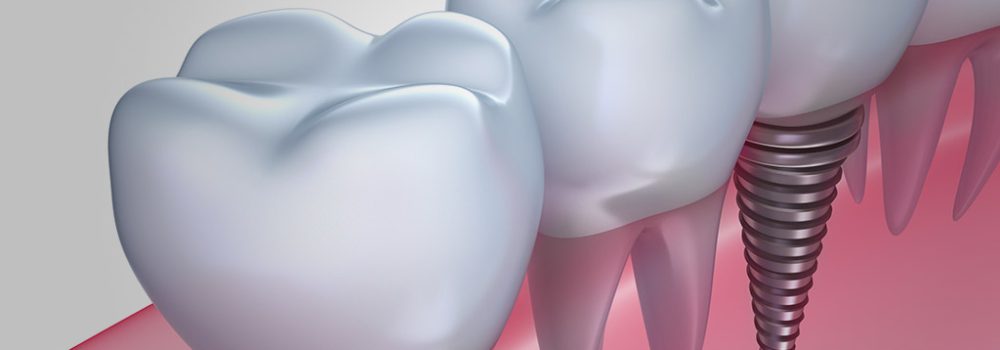 Guía de 5 Pasos sobre la Duración y Cuidado de Implantes Dentales