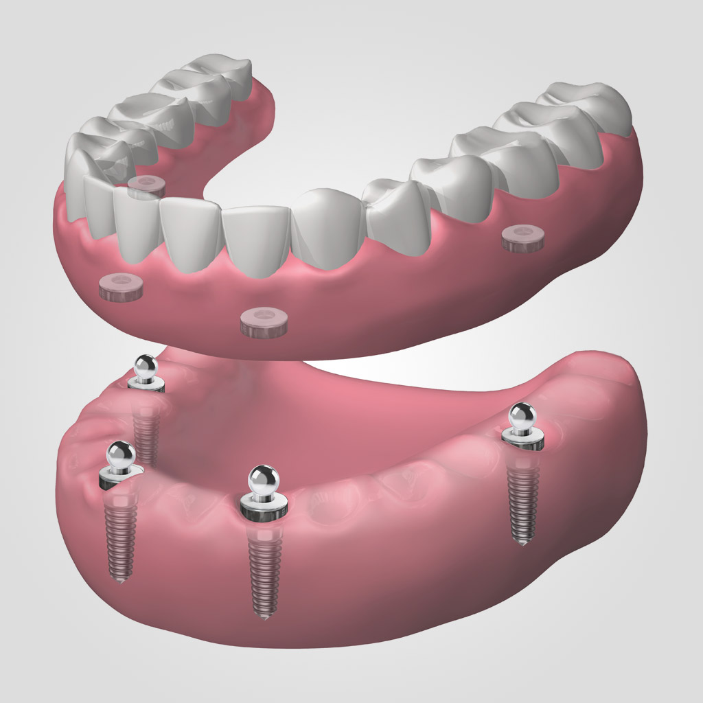 dentadura extraíble