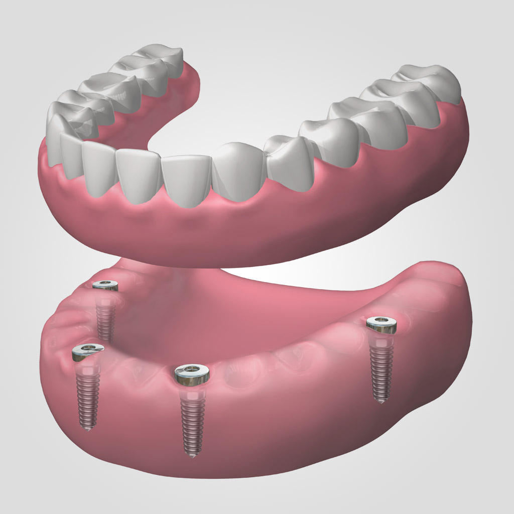 dentadura extraíble