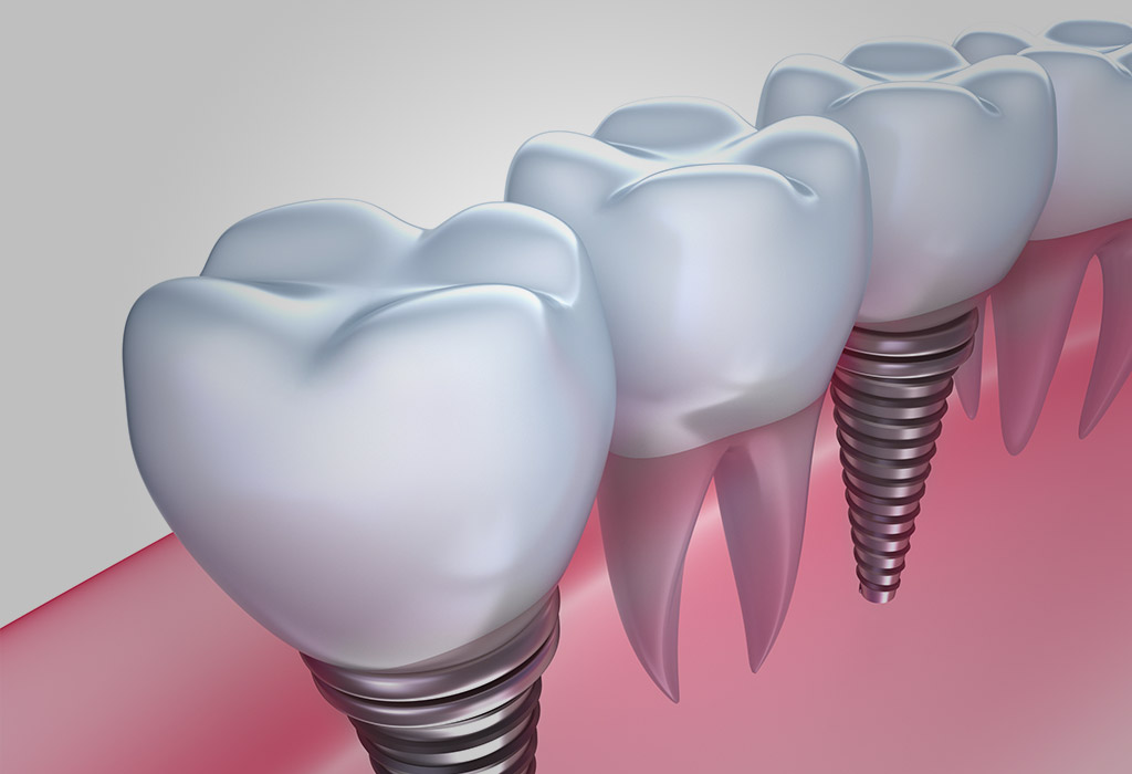 Guía de 5 Pasos sobre la Duración y Cuidado de Implantes Dentales