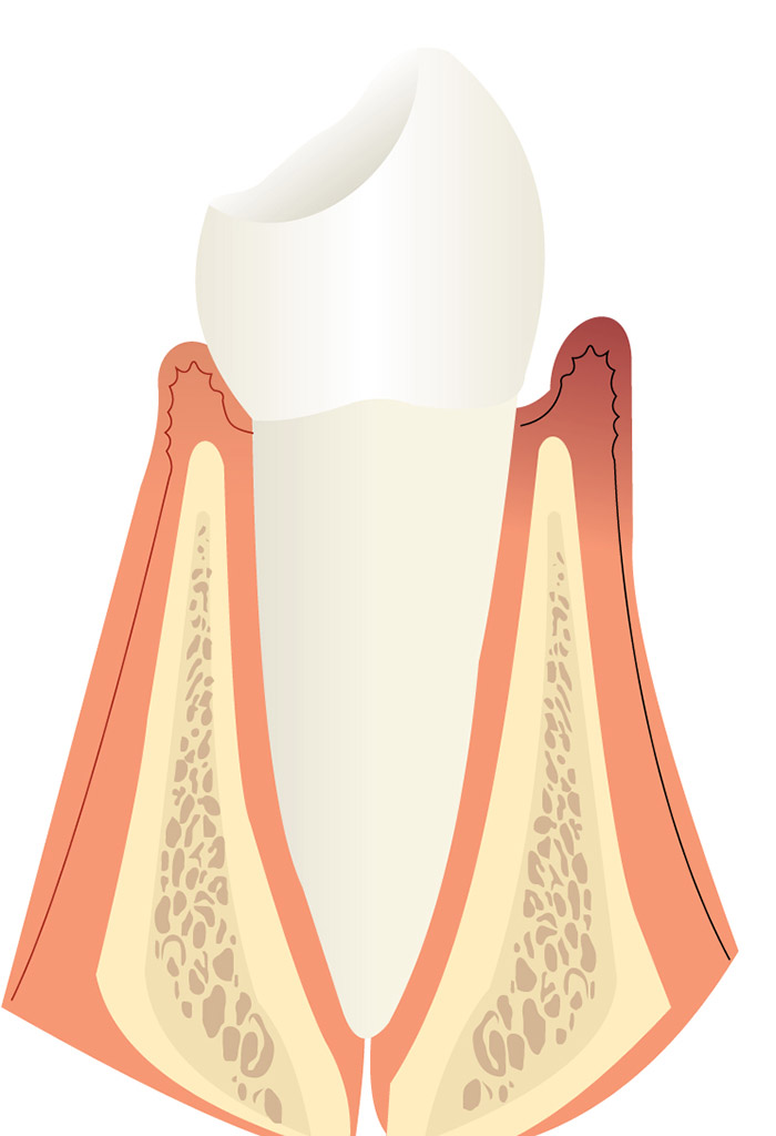 periodoncia en Roquetes Sant Pere de Ribes