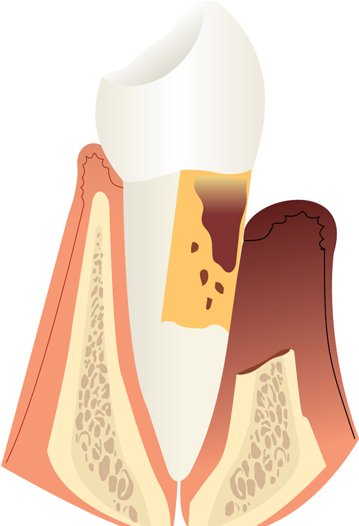 periodoncia en Roquetes Sant Pere de Ribes