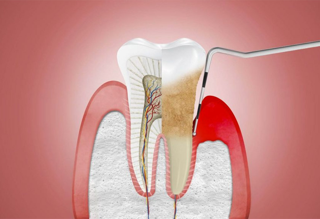 periodoncia en Roquetes Sant Pere de Ribes