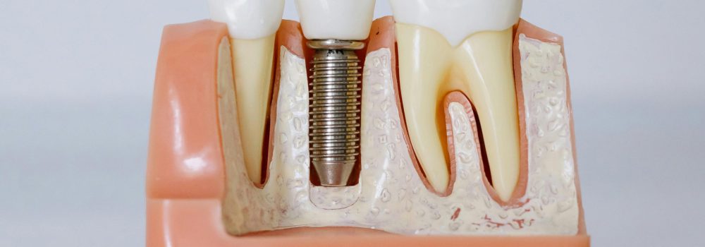 Mantenimiento y Limpieza de Implantes Dentales