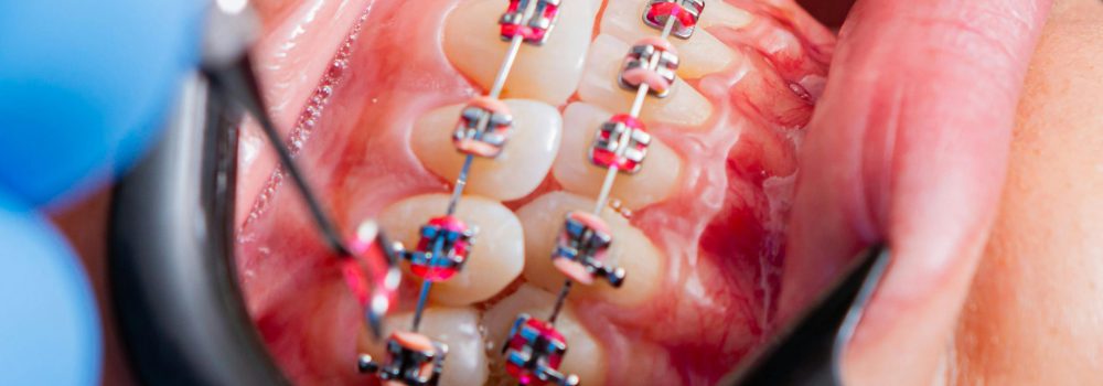 Consejos para Blanquear las Gomas Alrededor de tus Brackets