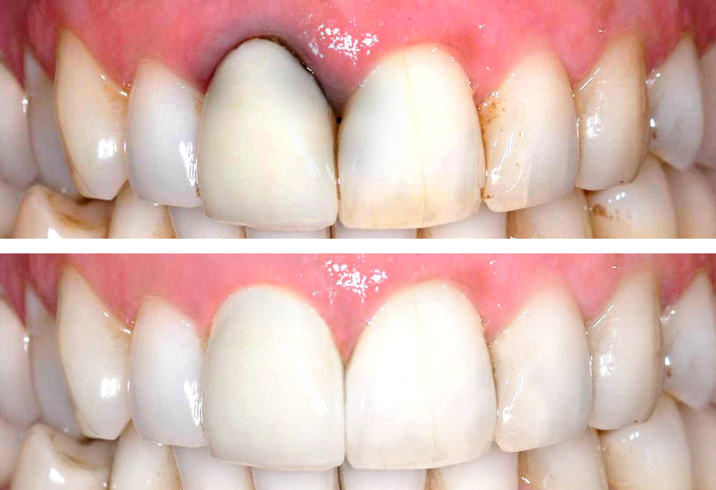 coronas de zirconio en Roquetes